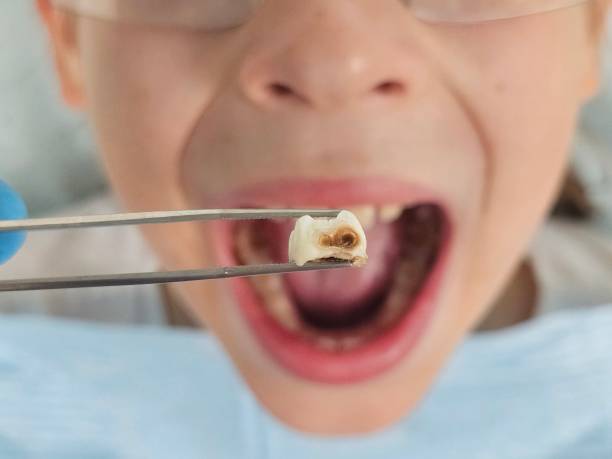 Best Root Canal Emergency Dentist  in Clinton, LA